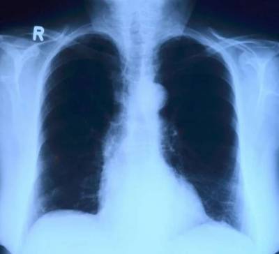 Медик рассказал, как защититься от пневмонии