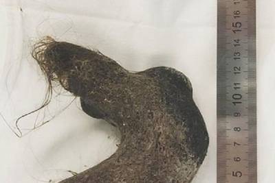 В Улан-Удэ из желудка девочки извлекли огромный клубок волос
