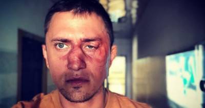 Прилучный прокомментировал сообщения СМИ о том, как он получил травму в Калининграде