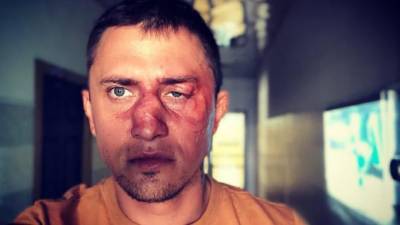 Актер Павел Прилучный восстанавливается в больнице после операции