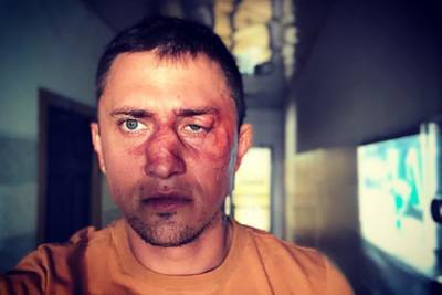 Прилучный опубликовал фото с разбитым лицом и рассказал о своем состоянии