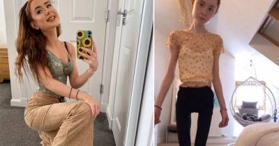 Страдающая от анорексии девушка показала фото, где она весит 25 кг