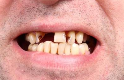 Выпадают зубы: врачи обнаружили страшное последствие коронавируса