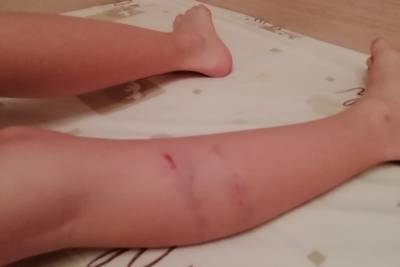 Охотничья собака искусала руки и ноги ребенка в тверском дворе