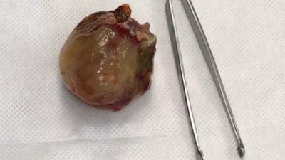 В "Елизаветинской больнице" провели операцию по удалению доброкачественной опухоли на открытом сердце
