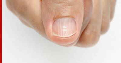 «Странные» пятна на ногтях могут «рассказать» о проблемах со здоровьем