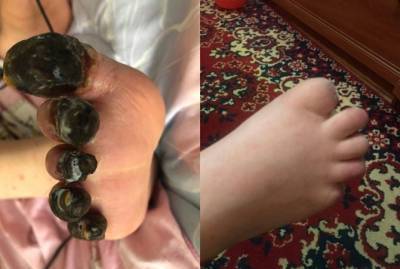 В Днепре ребенку ампутировали пальцы после отдыха на Красном море