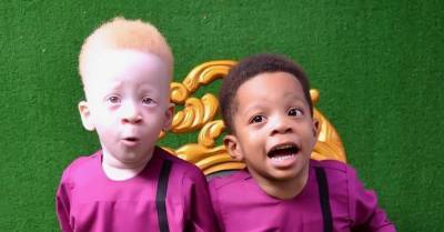Близнец темнокожего малыша оказался рыжим альбиносом — как выглядят необычные братья