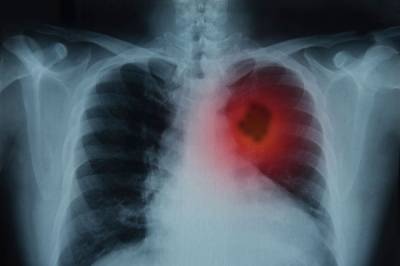 Рак легких – онкозаболевание с высокой смертностью: симптомы, профилактика и лечение