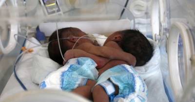 В Йемене врачи спасают новорожденных сиамских близнецов (4 фото)