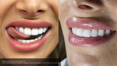 Стоматолог рассказал, как отбелить зубы в домашних условиях