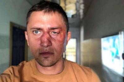 Павел Прилучный впервые показал лицо после избиения в Калининграде