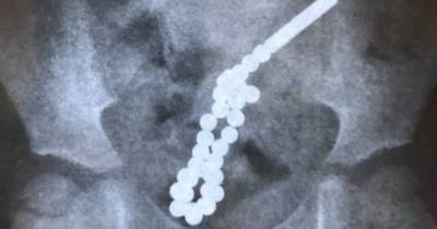 Во Львове двухлетняя девочка проглотила более 30 магнитных шариков, которые продырявили кишечник: появились фото (3 фото)