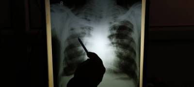 В Карелии 33 человека госпитализированы за сутки с пневмонией