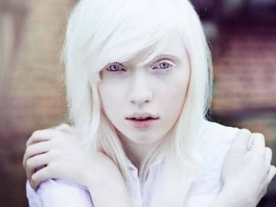 13 июня - Международный день распространения информации об альбинизме