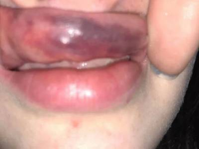 Пластический хирург в Шотландии изуродовал губы девушке и занес опасную болезнь