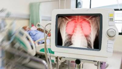 Covid-19 ведёт к длительным повреждениям лёгких у пациентов — исследования