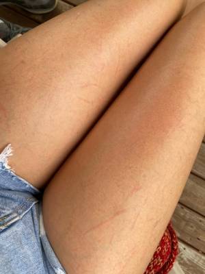 «Меня затягивало в болото!»: Леся Никитюк показала поцарапанные ноги