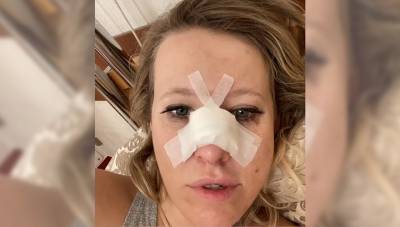 Неудачно упала: Ксения Собчак сломала нос и получила сотрясение