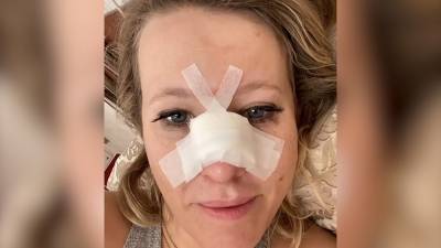 Ксения Собчак упала и сломала нос (видео)