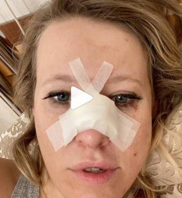 «Не сливали»: Ксения Собчак поблагодарила врачей за операцию на носу