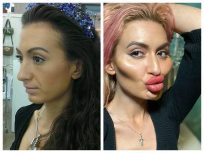 Блогерша из Киева экстремально увеличила губы и скулы: фото "до и после"