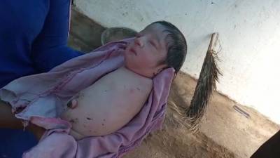 В Индии вследствие мутации родился ребёнок без ног и без рук