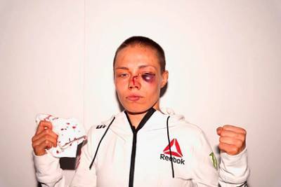 Гематома на лице девушки-бойца после турнира UFC испугала фанатов - lenta.ru