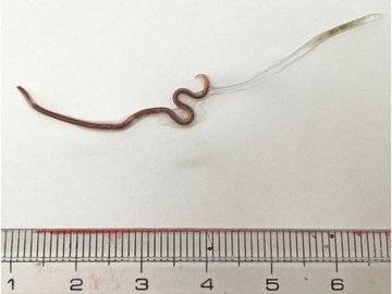 В миндалинах японки обнаружили живого червя после употребления сашими