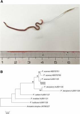 В Японии врачи достали 4-сантиметрового червя из горла девушки