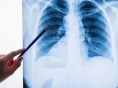 В профсоюзе медиков прокомментировали регистрацию Минздравом массовую пневмонию в Украине