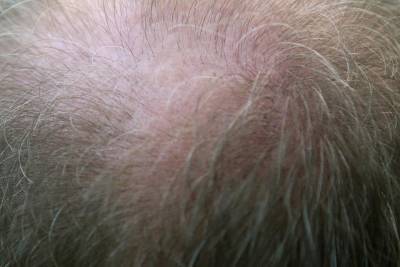 У переболевших коронавирусом выпадают волосы