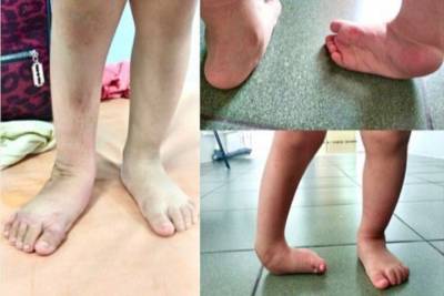 В Улан-Удэ врачи смогли вылечить «косолапую» девочку с вывернутой ножкой