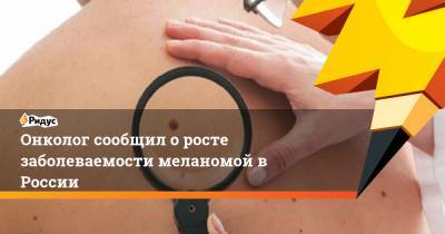 Онколог сообщил о росте заболеваемости меланомой в России