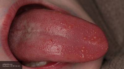 Австралийские стоматологи назвали заболевания, которые выдает состояние языка