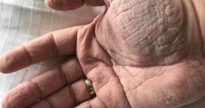 "Злость и отчаяние": врач показал свои руки после работы с больными COVID-19