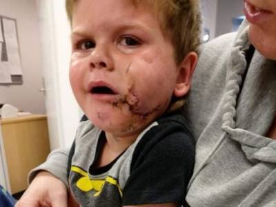 Двухлетний мальчик не поделил с собакой еду и потерял половину лица