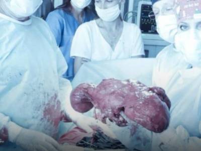 Во Львове врачи удалили женщине 10–килограммовую опухоль, которая вросла в почку