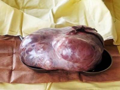 Хирурги на Волыни удалили девочке гигантскую опухоль в 3 кило