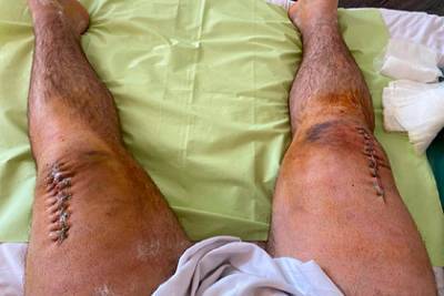 Сломавший ноги при приседании со штангой тяжелоатлет показал последствия травмы