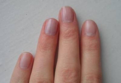 Синие ногти могут быть признаком опасной болезни