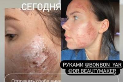 В Ярославле горе-косметологи сожгли лицо пациентке