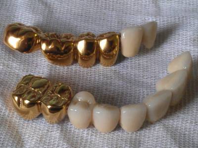 На Ровенщине стоматолог воровал золото для протезов: обогатился на сотни тысяч