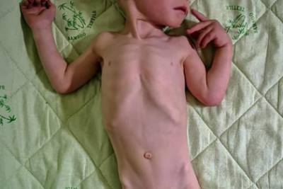В российском «концлагере для детей» нашли худого ребенка с деформацией черепа