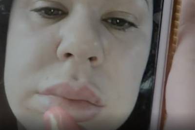 Неумелый врач оставил женщину с губами «в виде сосисок» на два года