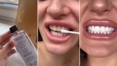 Дикие советы в Сети: врачи в ужасе от отбеливания зубов перекисью водорода
