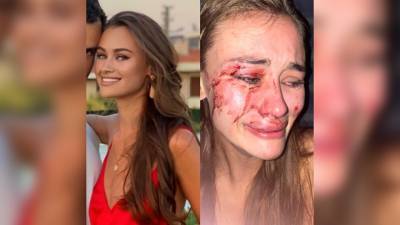На жалобу об избиении на пляже в Турции модели ответили, что виновата сама