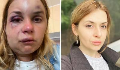 Анастасия Луговая - Журналистке, которую избили в поезде, стало хуже: появились новые фото - politeka.net