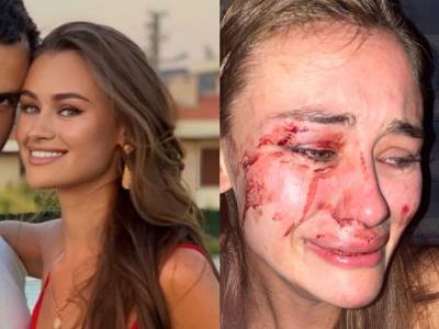 Украинскую модель Дарью Кирилюк и ее парня избили в Турции охранники