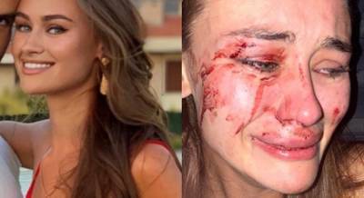 Избиение украинской топ-модели в Турции: девушку обвинили в клевете